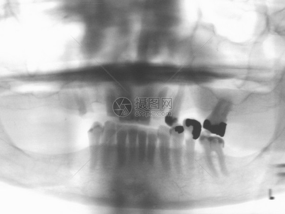 显示牙齿缺失的X光图片