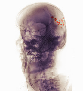  X光片图片