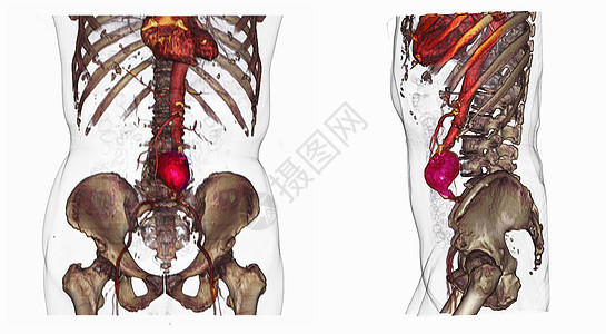 两张心腹动脉的CT扫描图像图片