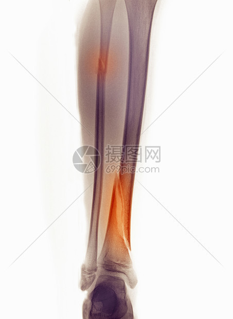 显示纤维骨折和蒂比亚的X光腿图片