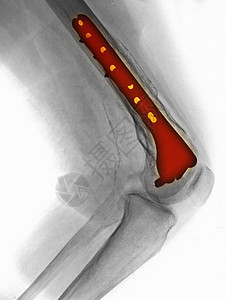 腿部X光片显示股骨骨折图片