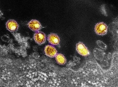 艾滋的透射电镜图片