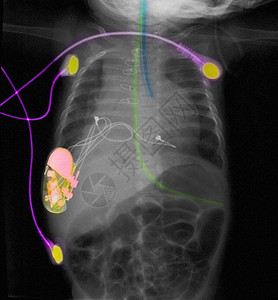对4个月大的女婴进行X光检查图片