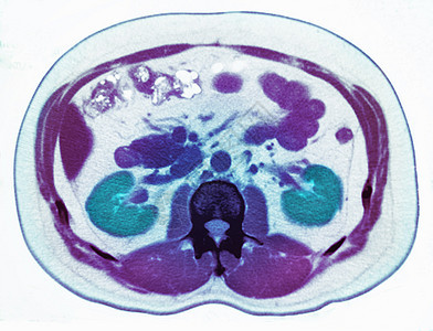 显示肾结石的CT扫描图片