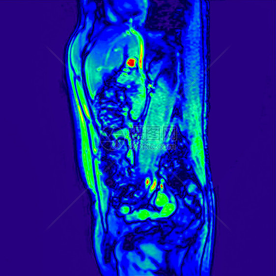 对60岁患有肾结石的男病人侧视图abdomenMRI扫描图片
