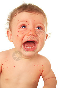 麻疹的哭泣宝贝男孩图片