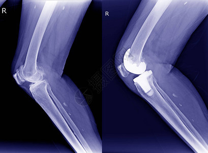 X射线膝盖右骨髓炎OA和手术后关节图片