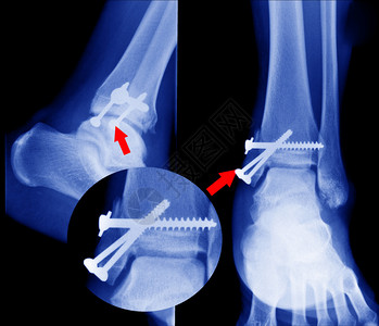 射线骨折图片
