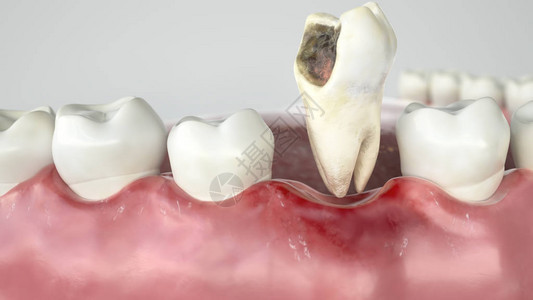 龋齿分三个阶段第3阶段拔牙背景图片