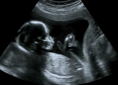 四个月的胎儿产科超声图片
