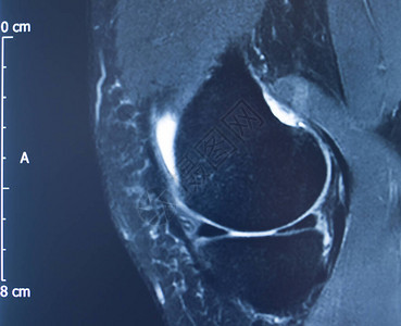膝部受伤米克2级撕裂磁共振成像矫图片