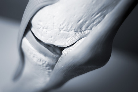 膝关节骨膜炎为肿瘤学和矫形科的图片