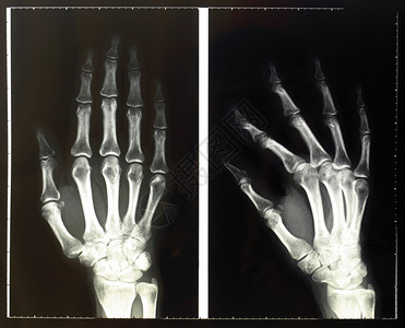 用于骨骸诊断放射学的手指X射线图片