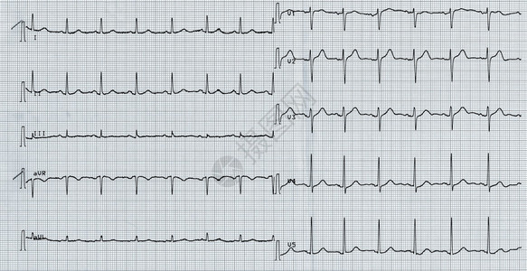 用于测量心跳的电动心电图KAEKGElektrokardig图片