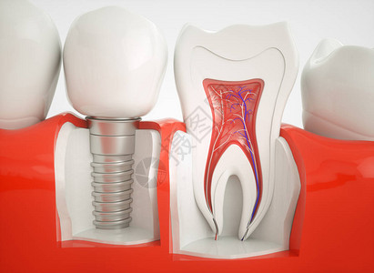 健康的牙齿和植入器图片