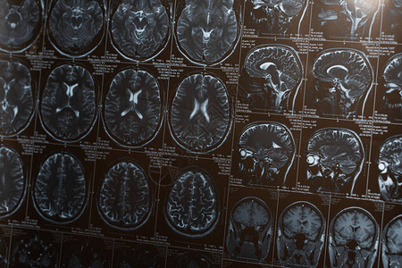 大脑的磁共振成像阿尔茨海默病的概念图片