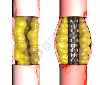 冠状动脉搭桥手术是一种使阻塞的冠状动脉恢复正常血流的外科手术图片