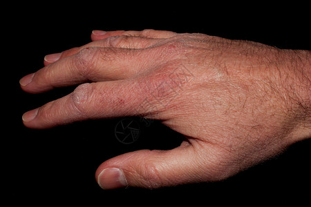 一个男人的右手皮肤干燥的特写镜头图片