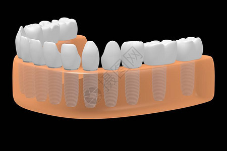 种植牙种植牙背景图片