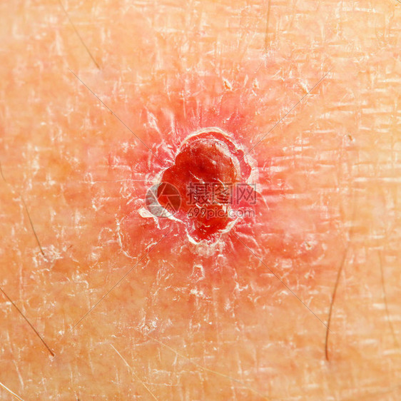 人类皮肤上有咬痕刺痛或疼痛症状接图片