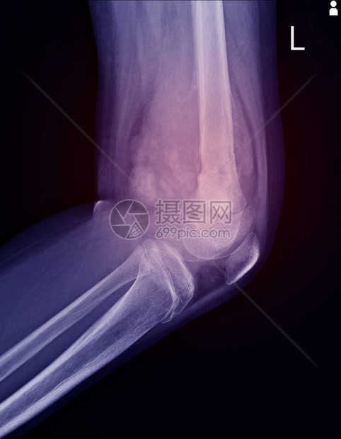 膝关节X线片显示左股骨远端内侧有大的溶骨病变图片