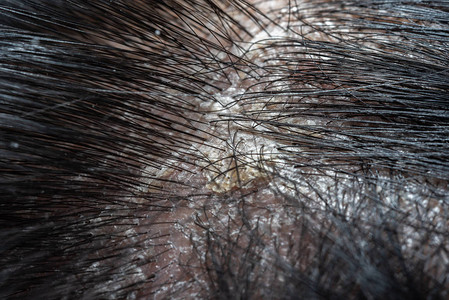 黑头发的人类有问题因为荷尔蒙脏乱和压力等原因皮肤病导致淋巴虫图片