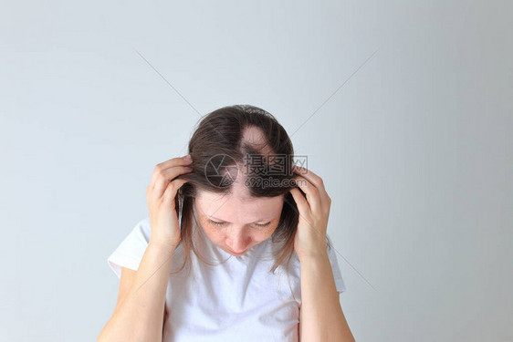 一个年轻女孩的真正斑秃一个人的光头弥漫脱发雄激素脱发脱发头上有图片