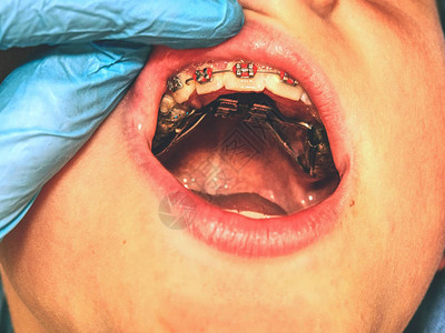 牙齿矫形牙科主题方法牙齿校正Hyrax和包皮扩张图片
