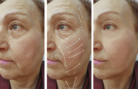 脸部老年妇女皱纹手术前后图片