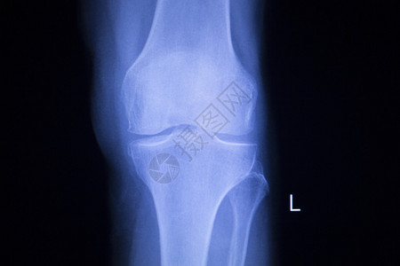 Knee和meniscus受伤医疗X射线测试图片