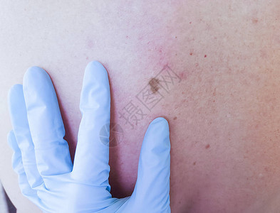 皮肤科医生检查患者背部的痣图片
