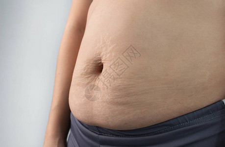 近距离显示腹部皮肤有伸展痕和产后松动的皮肤的妇女图片