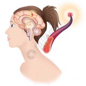 描述缺血中风或脑血管意外CVA背景图片
