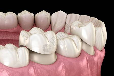Porcelain王冠放置在前摩尔牙和磨牙上医学精图片