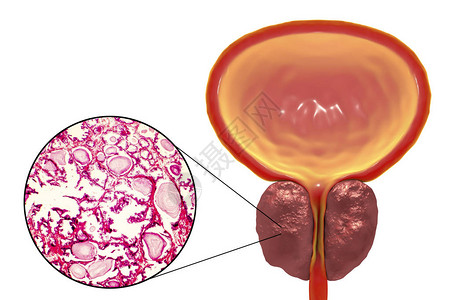 显微照片显示腺体扩张图片