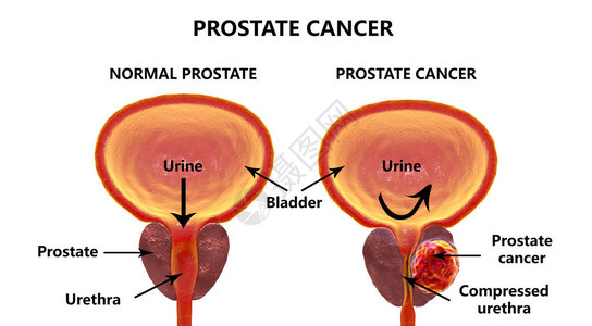 前列腺癌图片