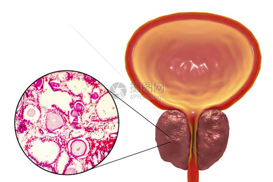 显微照片显示腺体扩张图片