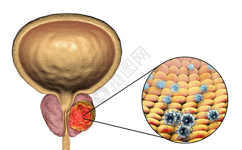前列腺癌原学的概念图3D插图显示感染前列腺并发图片