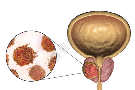 前列腺癌3D图例显示前列腺内的肿瘤和癌图片