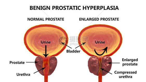 3D图解显示正常和膨胀的前列腺本图片
