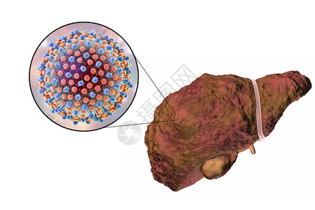 吉首酸肉肝硬化阶段丙型肝炎感染的肝脏和丙型肝炎HCV3D插设计图片