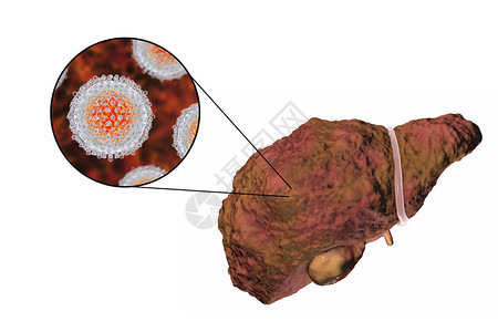 肝硬化阶段丙型肝炎感染的肝脏和丙型肝炎HCV3D插图片