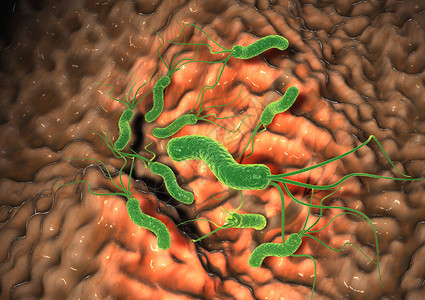 3D说明显示损害粘结层胃炎的图片