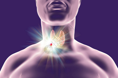 甲状腺肿瘤的破坏3D图解甲状腺癌治图片