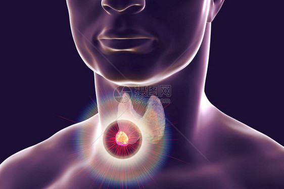 甲状腺肿瘤的破坏3D图解甲状腺癌治图片