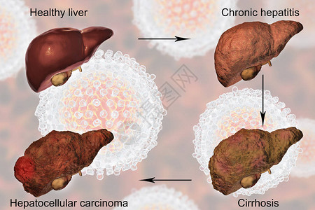 肝炎C感染的肝病例增图片