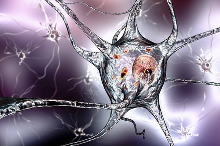 帕金森病3D插图显示含有路易体小红球的神经元图片