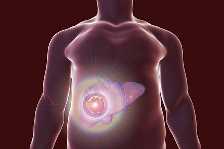 肝癌治疗概念图像3D插图图片