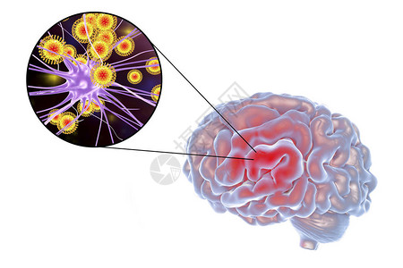 张公山寨3D插图显示大脑和突变神经元设计图片