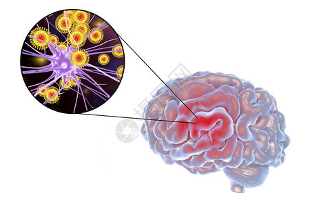 3D插图显示大脑和突变神经元图片